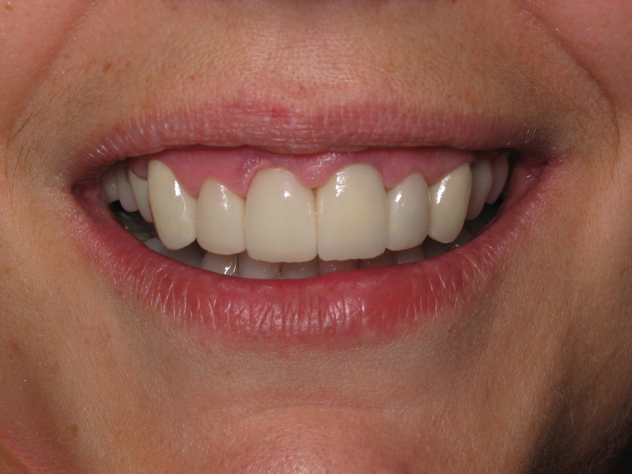June-after-teeth-copy