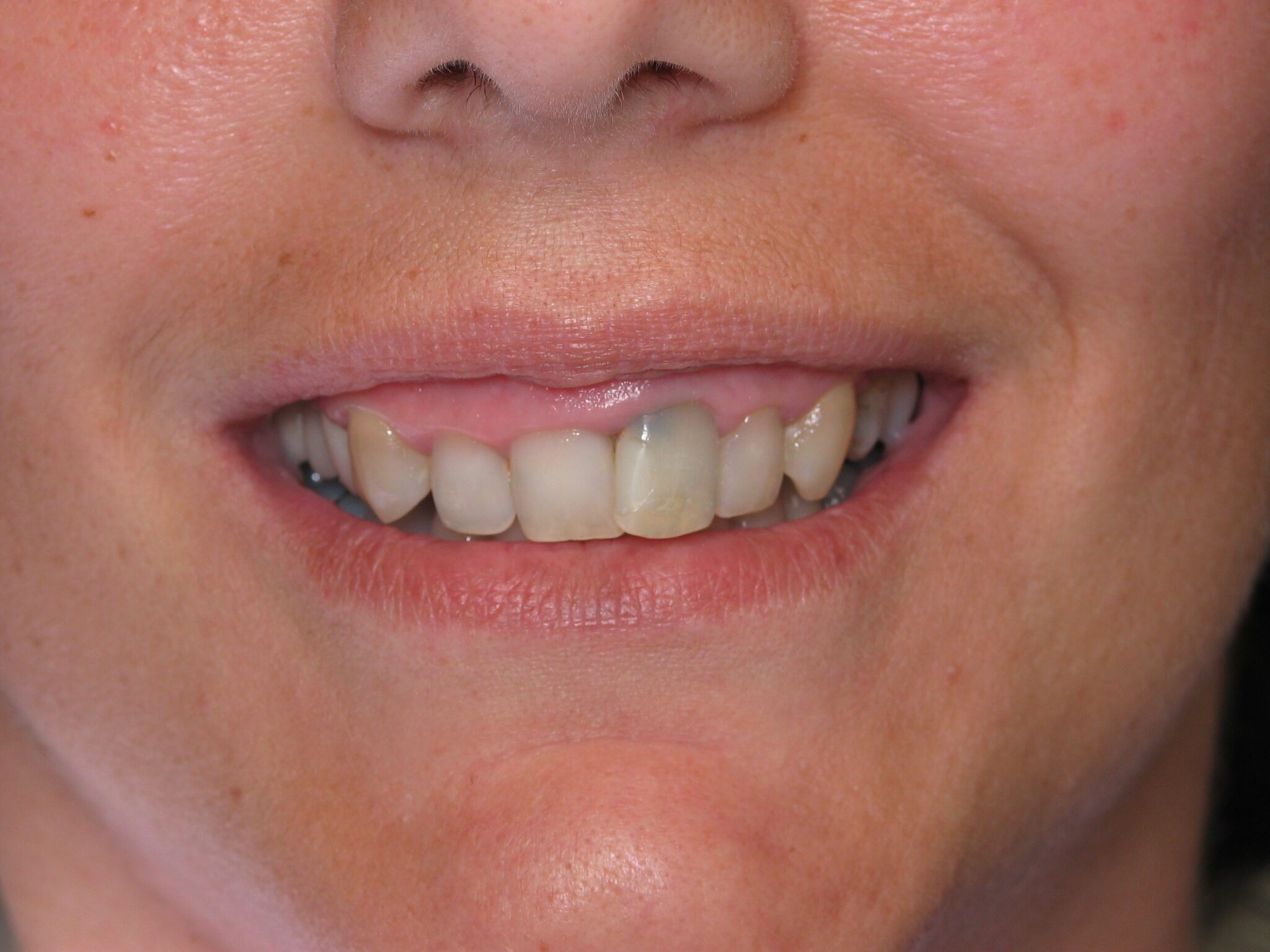 June-before-teeth-only